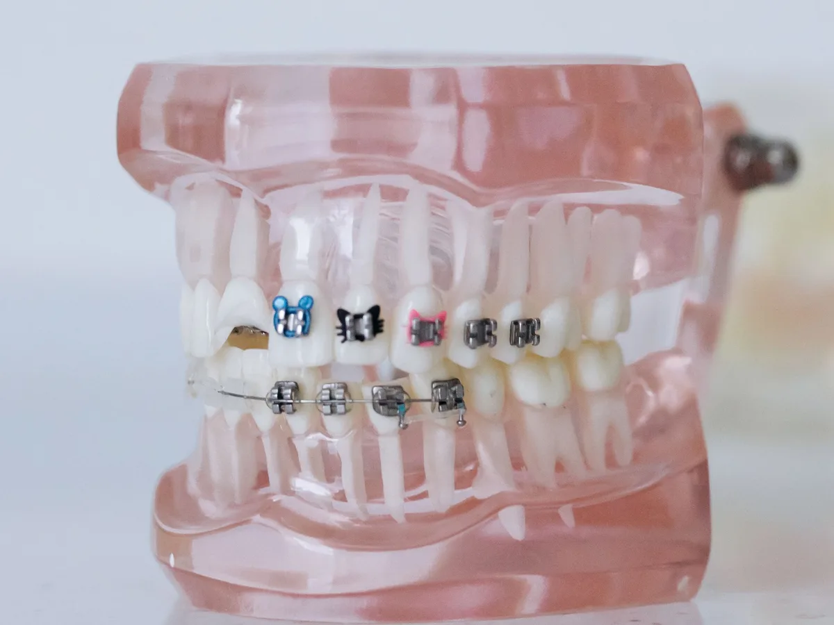 Dental model showing metal and ceramic braces used for orthodontic planning.