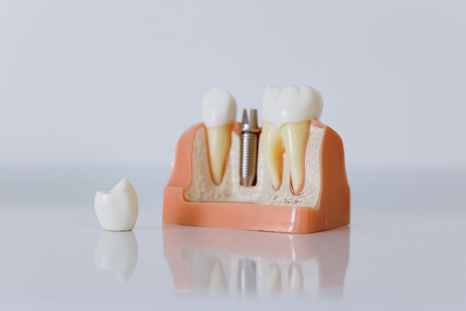 Close-up dental implant model showing artificial teeth and jaw structure.