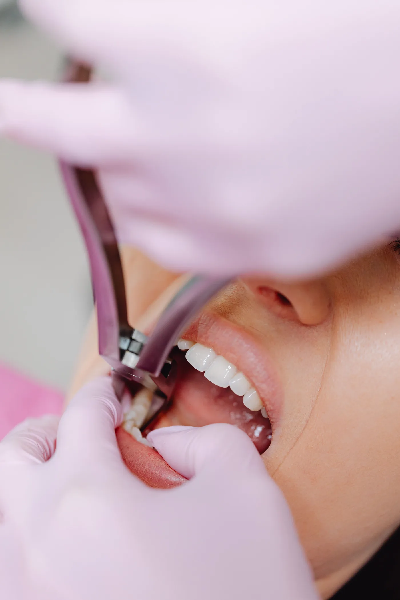 Close dental treatment scene showing a clinician working inside a patient's mouth.