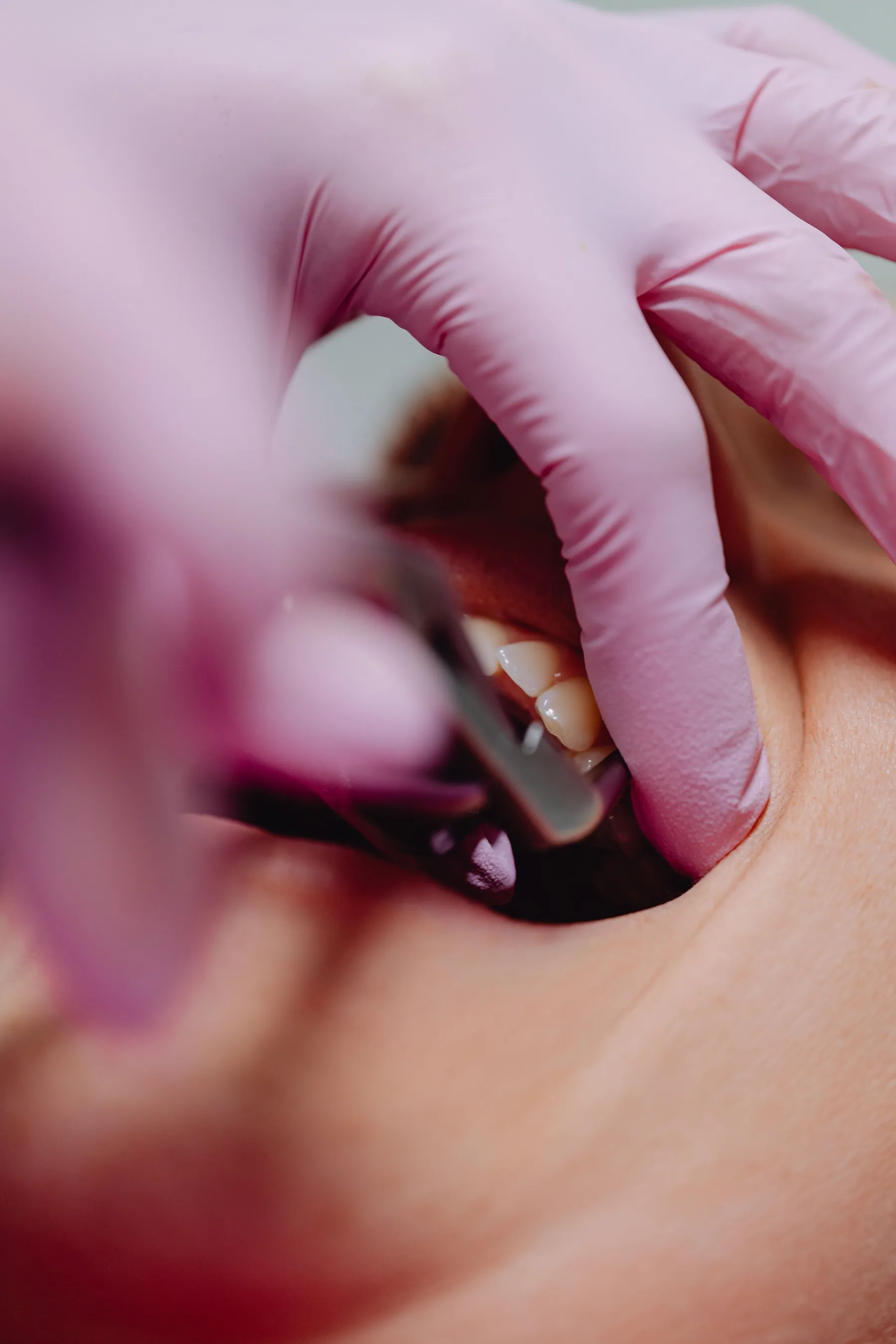 Close-up dental treatment scene focused on gum and tooth surface examination.