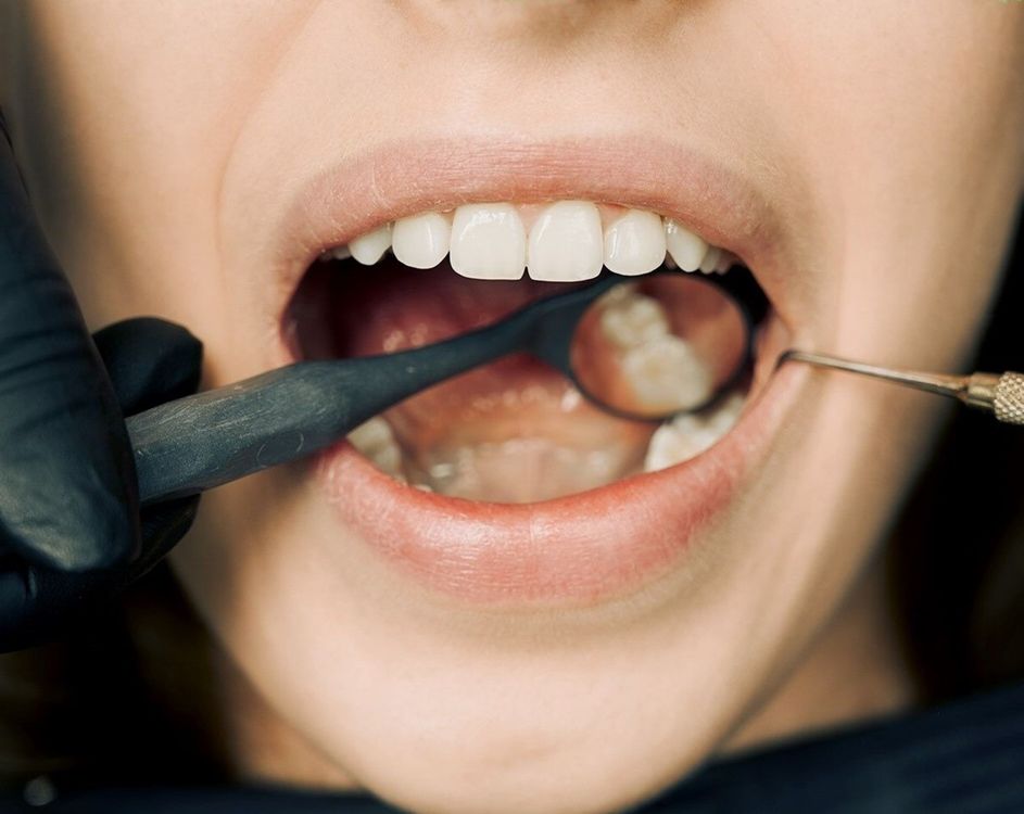 Close-up dental examination with mirror and professional cleaning equipment during preventive care.