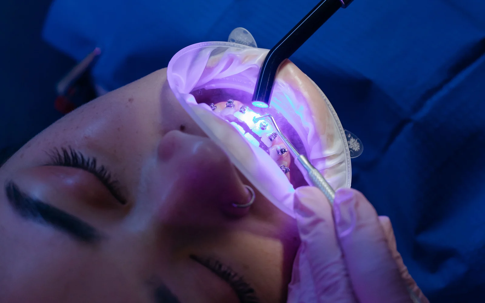 Professional teeth whitening treatment using a dental light during supervised in-clinic care.
